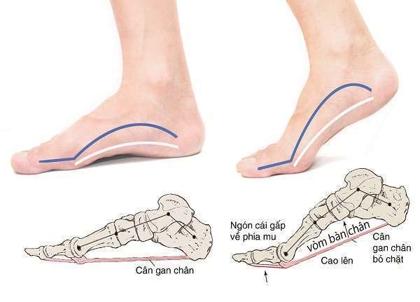 Chọn giày cầu lông theo hình dáng bàn chân